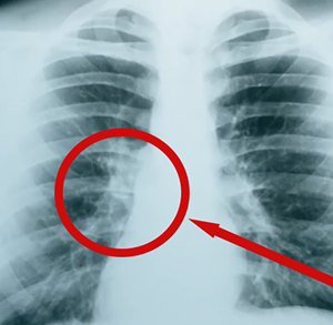 Lung Cement Breakthrough Video